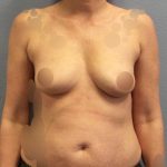 Breast Augmentation Before & After Patient #1411