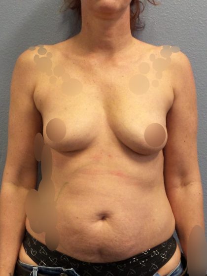 Breast Augmentation Before & After Patient #1411