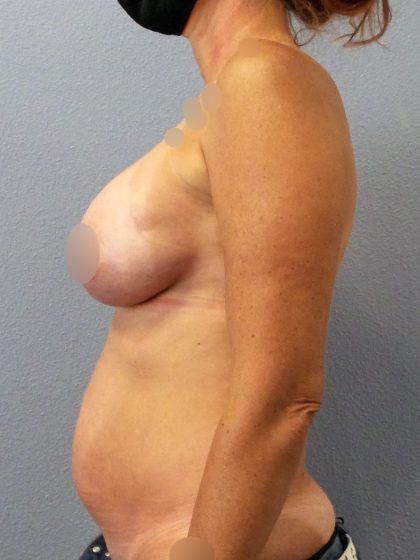 Breast Augmentation Before & After Patient #1411