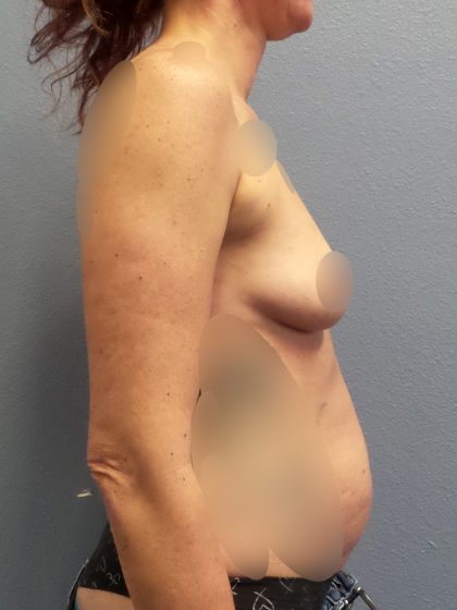 Breast Augmentation Before & After Patient #1411