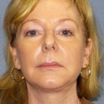 Facelift Before & After Patient #909