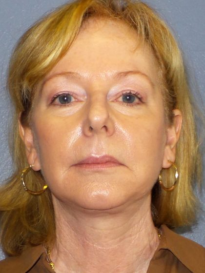 Facelift Before & After Patient #909