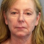 Facelift Before & After Patient #909