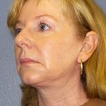 Facelift Before & After Patient #909