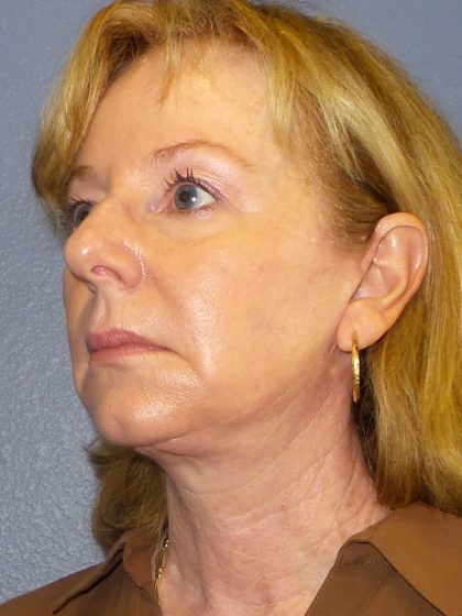 Facelift Before & After Patient #909