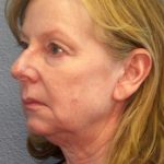 Facelift Before & After Patient #909