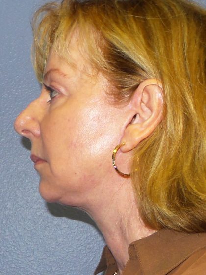 Facelift Before & After Patient #909