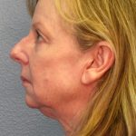 Facelift Before & After Patient #909