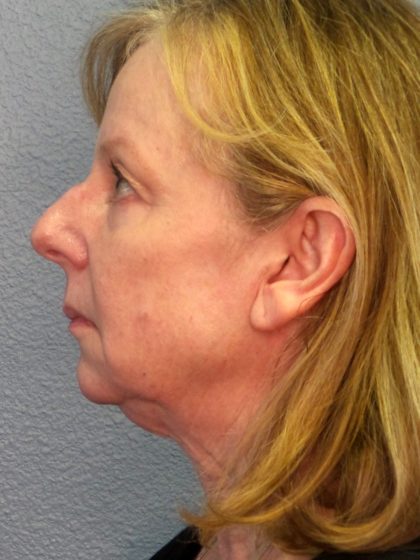 Facelift Before & After Patient #909