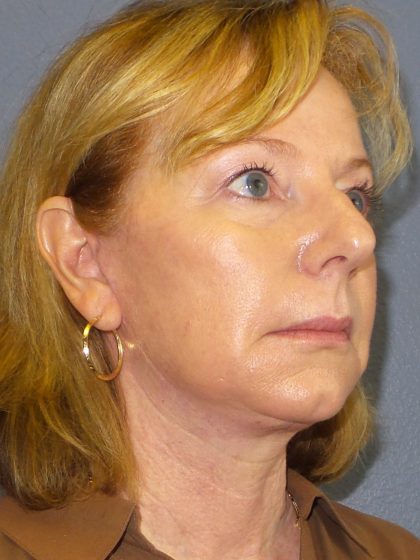 Facelift Before & After Patient #909