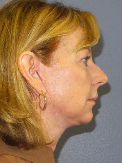 Facelift Before & After Patient #909