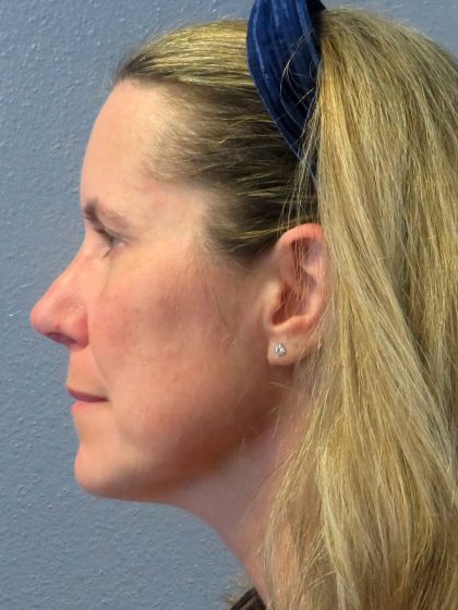 Revision Rhinoplasty Before & After Patient #213