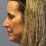 Revision Rhinoplasty Before & After Patient #213