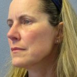 Rhinophyma Before & After Patient #1300