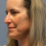 Rhinophyma Before & After Patient #1300