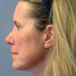 Rhinophyma Before & After Patient #1300