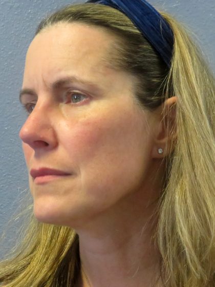 Rhinoplasty Before & After Patient #482