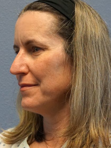 Rhinoplasty Before & After Patient #482