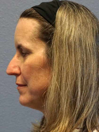 Rhinoplasty Before & After Patient #482