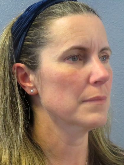 Rhinoplasty Before & After Patient #482