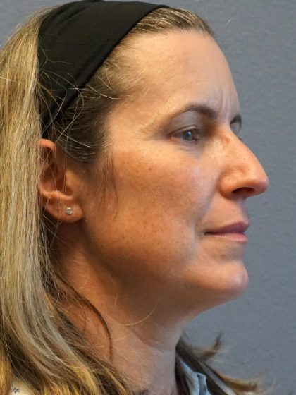 Rhinoplasty Before & After Patient #482