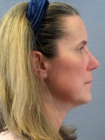 Rhinoplasty Before & After Patient #482