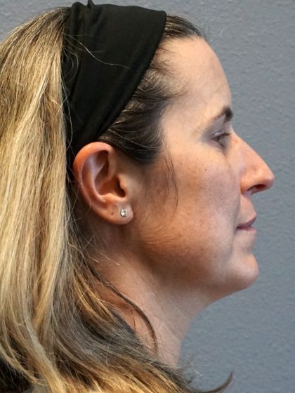 Rhinoplasty Before & After Patient #482