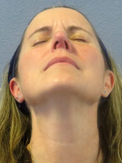 Rhinoplasty Before & After Patient #482