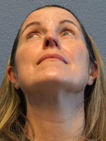 Rhinoplasty Before & After Patient #482