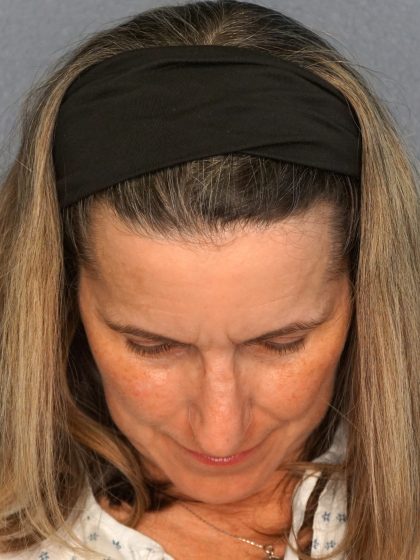 Rhinoplasty Before & After Patient #482