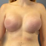 Breast Augmentation Before & After Patient #1535