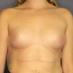 Breast Augmentation Before & After Patient #1535