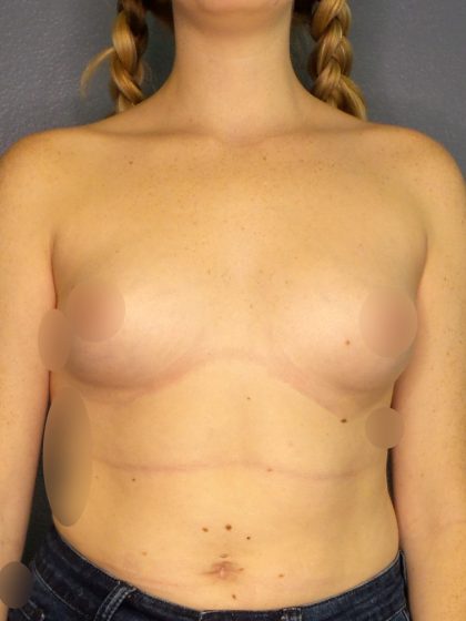 Breast Augmentation Before & After Patient #1535