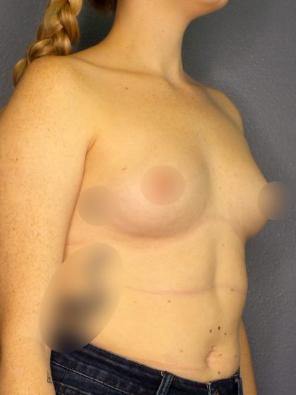 Breast Augmentation Before & After Patient #1535