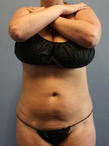 Liposuction Female Before & After Patient #1155