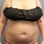 Liposuction Female Before & After Patient #1155