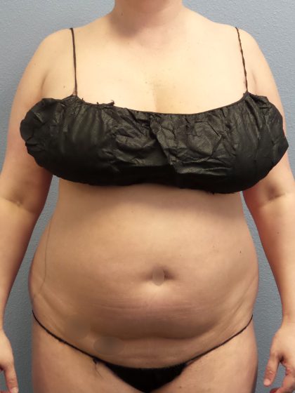 Liposuction Female Before & After Patient #1155
