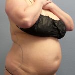 Liposuction Female Before & After Patient #1155