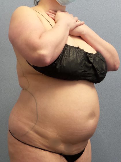 Liposuction Female Before & After Patient #1155