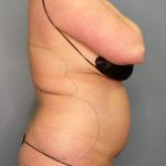 Liposuction Female Before & After Patient #1155
