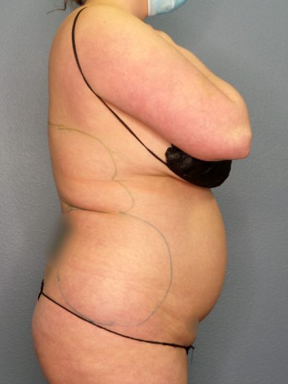 Liposuction Female Before & After Patient #1155