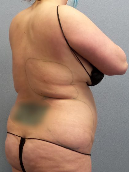 Liposuction Female Before & After Patient #1155