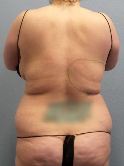 Liposuction Female Before & After Patient #1155
