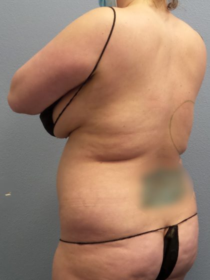 Liposuction Female Before & After Patient #1155