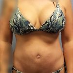 Abdominoplasty Before & After Patient #2053