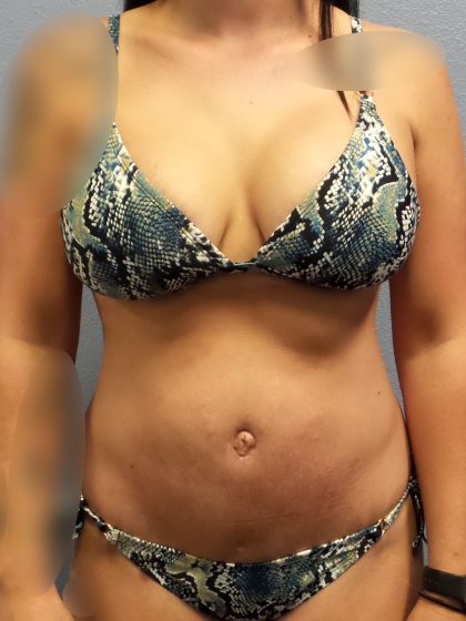 Abdominoplasty Before & After Patient #2053