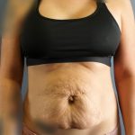 Abdominoplasty Before & After Patient #2053