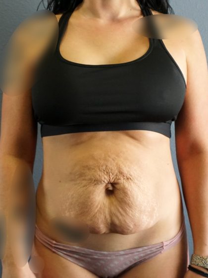 Abdominoplasty Before & After Patient #2053