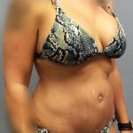 Abdominoplasty Before & After Patient #2053