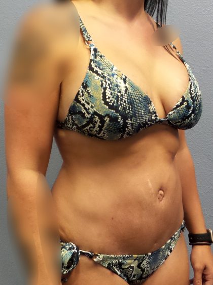 Abdominoplasty Before & After Patient #2053
